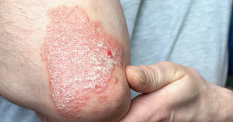 betaderm cream