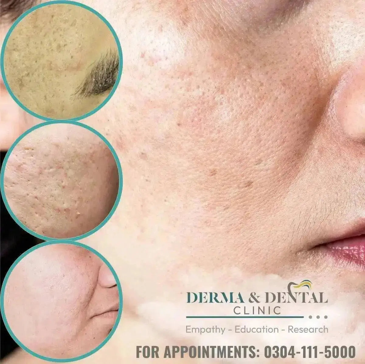 Acne scars removal treatment