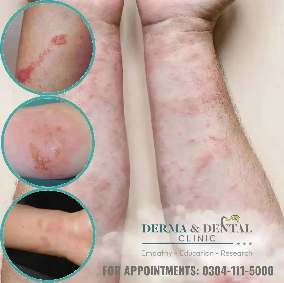 Eczema with Derma & Dental Clinic