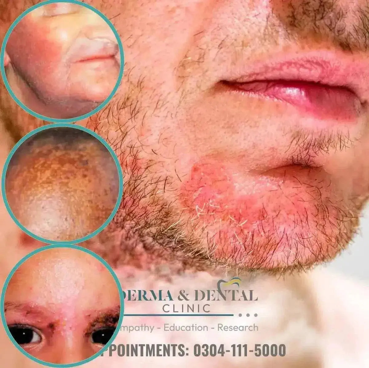 Seborrheic Eczema at Derma & Dental