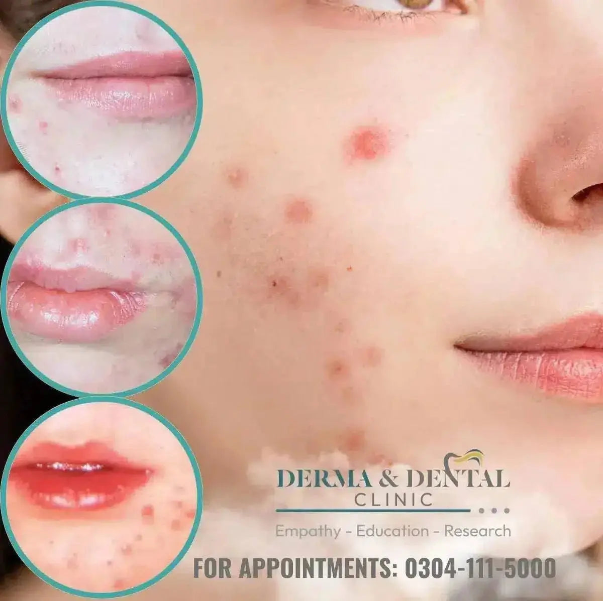 Acne Solutions at Derma & Dental Clinic