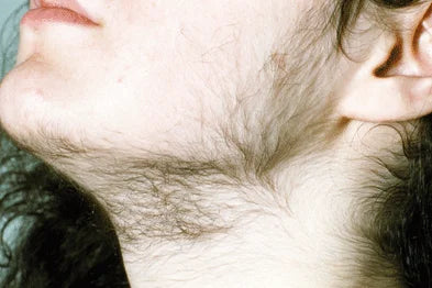 hirsutism
