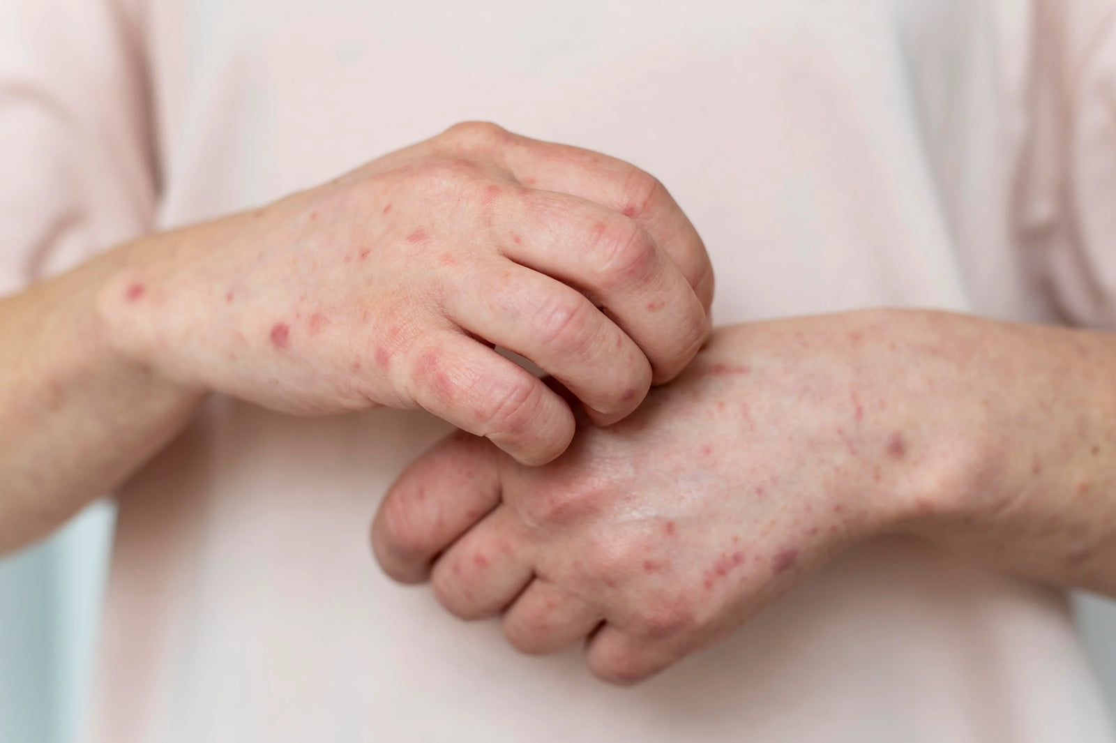 scabies