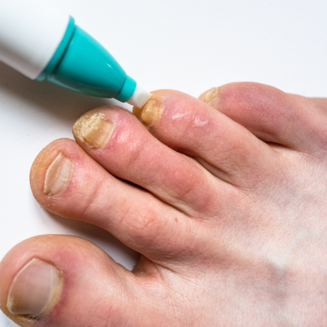 Fungal infections