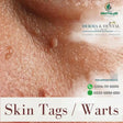 Advanced Dermatology Solutions: Expert Skin Tag and Wart Treatments - dermatologists.pk