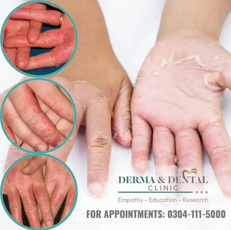 Hand Eczema Treatment at Derma & Dental Clinic