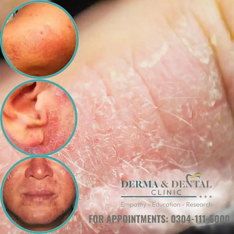 Experience Relief from Photocontact Eczema at Derma & Dental Clinic - dermatologists.pk