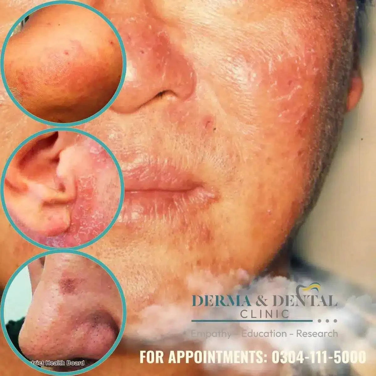 Find Relief from Chronic Actinic Dermatitis at Derma & Dental Clinic - dermatologists.pk