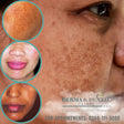 Melasma