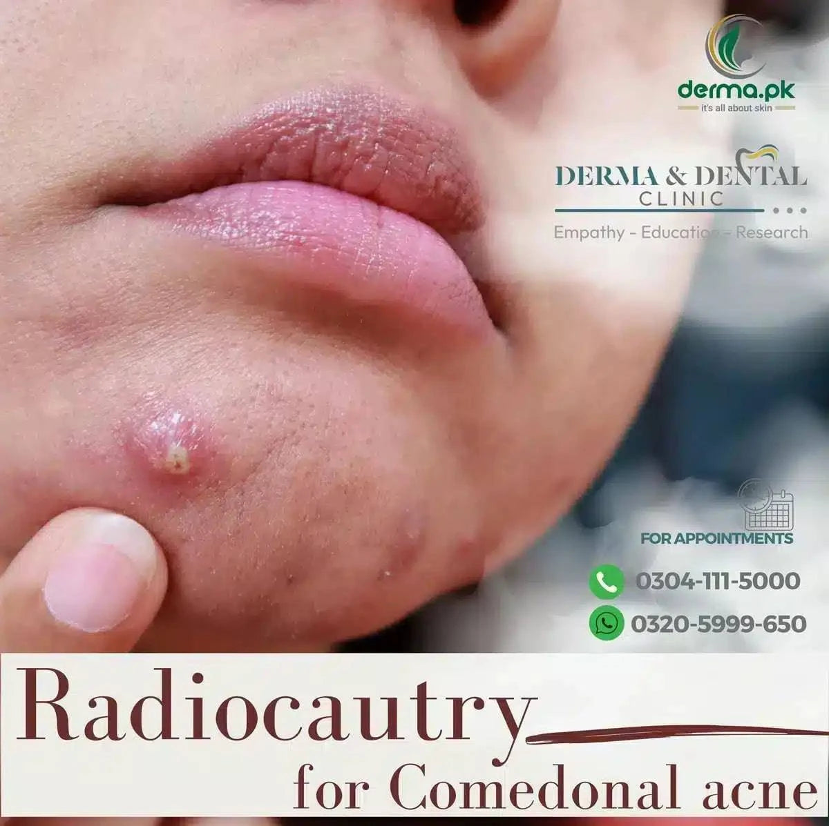 Comedonal Acne