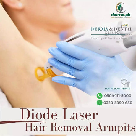 Advanced Diode Laser Hair Removal for Armpits at Derma & Dental Clinic - dermatologists.pk