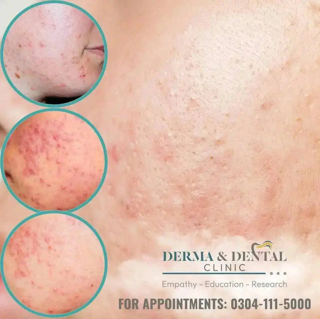 Conquer Nodulocystic Acne 