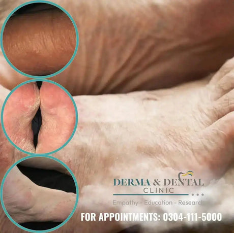 eczema treatment at derma and dental